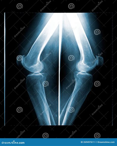 X-ray of Both Human Knee, Side View. Stock Image - Image of examination, scan: 269497611