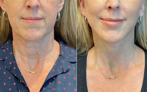 Facelift And Neck Lift Austin Tx Dr Weinfeld