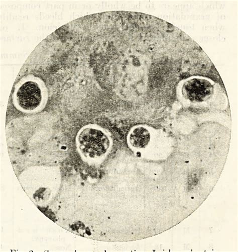 Figure From The Treatment Of Rhinosporidiosis In Man Based On The