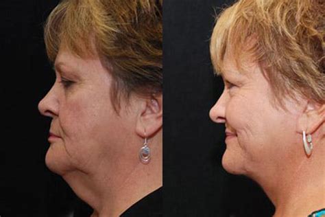 Neck Lift Cincinnati Oh Mini Neck Lift Alexander Donath Md