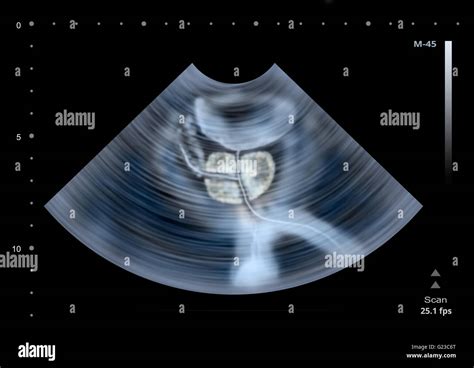 Ultrasound Scan Of Human Prostate Illustration Stock Photo Alamy