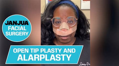 Part 1 Open Tip Plasty And Alarplasty On African American Female Dr Tanveer Janjua New