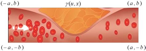 Schematic diagram of atherosclerotic with a plaque growth. | Download ...