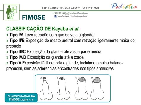 Fimose