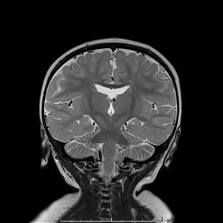 Septo Optic Dysplasia Radiology Case Radiopaedia Org