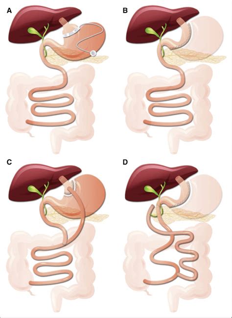 Current Procedures For Metabolic Surgery The 4 Current Metabolic