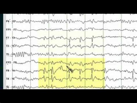 Normal Eeg Tracing