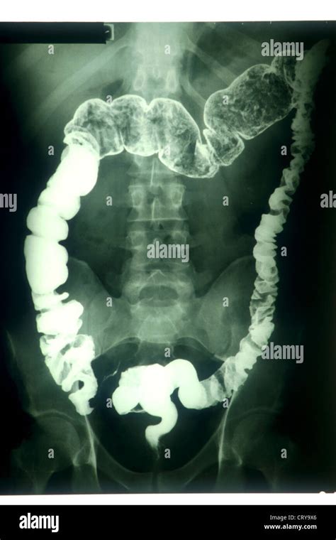 Colitis Ulcerosa X Ray Stockfotografie Alamy