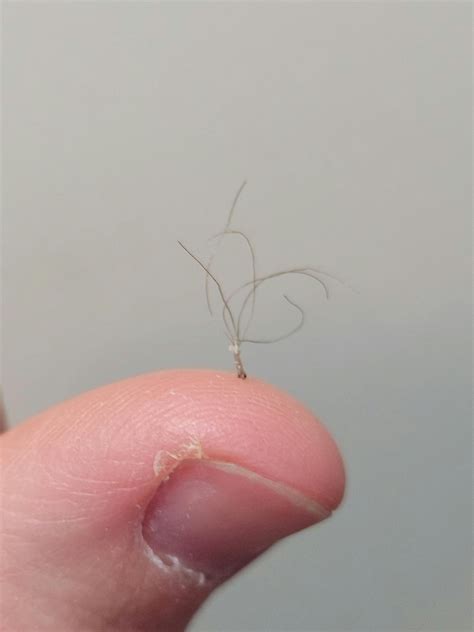 Pili Multigemini Multiple Hairs Growing From The Same Follicle R