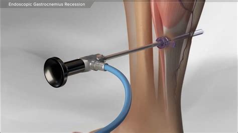 Endoscopic Gastrocnemius Recession - YouTube