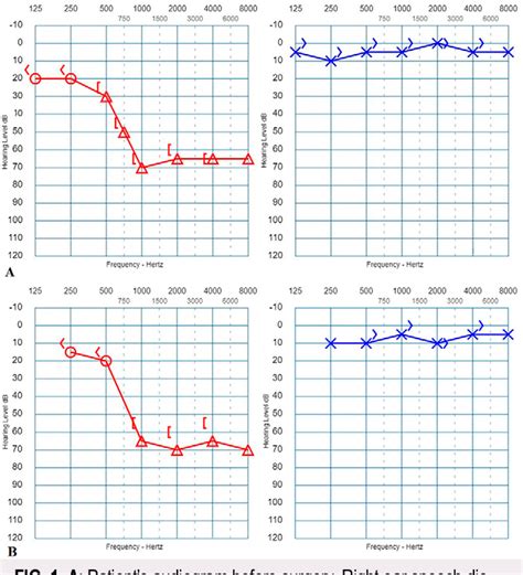 [pdf] Contralateral Tinnitus And Hearing Loss Due To A Tumor At The Region Of Inferior