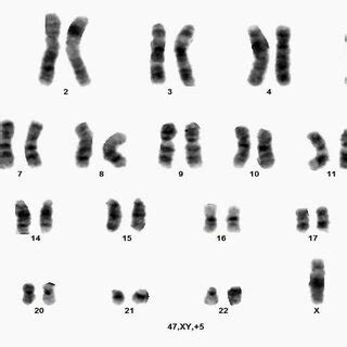 Immunophenotypic analysis performed on peripheral blood showing blasts ...