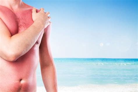 7 Foods To Eat To Help Prevent Sunburn Sunburn Skin Protection Better Skin