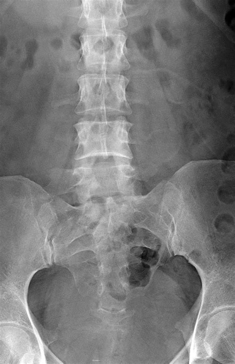 Transitional Anatomy Lumbar Spine - Human Anatomy