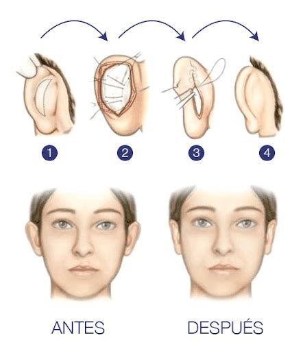 Otoplastia Que Es La Cirug A Est Tica De Cambiar La Forma De Las Orejas