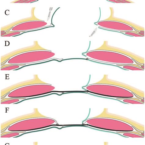 Schematic Figure Of The Steps For The Modified Peritoneal Flap Download Scientific Diagram