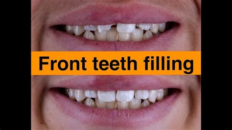 Best Tooth Filling Near Unity Dental Care Houston