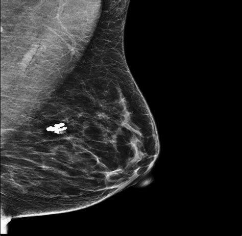 A mammogram of the left breast showed a left breast lesion with ...