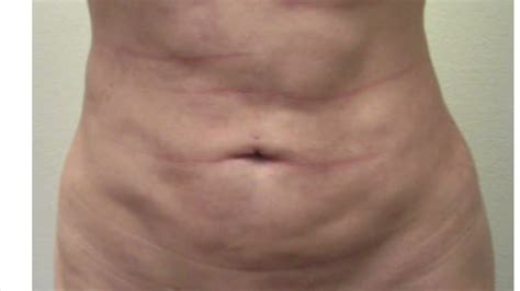 Understanding Liposuction Revision With Dr Kenneth Hughes In Los