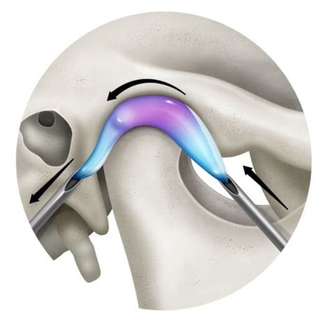 Artrocentesis De La Articulaci N Temporomandibular Qu Es Y Para Qu