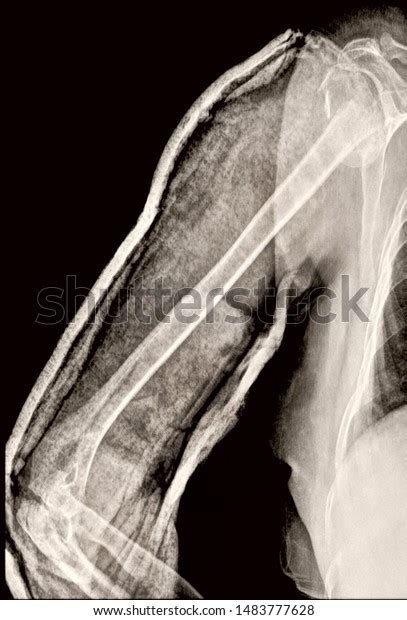 X Ray Fracture Humerus Stock Photo 1483777628 | Shutterstock