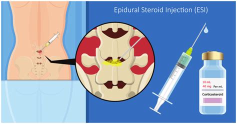 Epidural Steroid Injection Needle