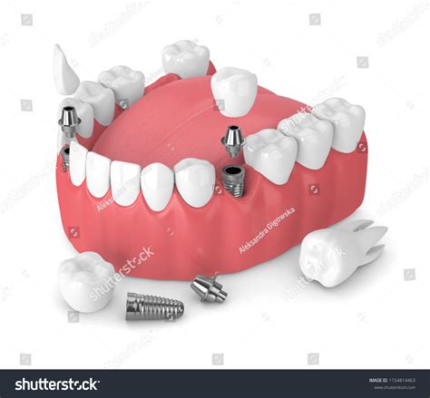 D Render Jaw Dental Implants Bridges Stock Illustration