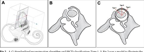 Figure 1 From New Classification Of Superior Semicircular Canal Dehiscence In Hrct Semantic