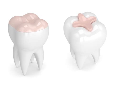 Dental Crowns Vs Inlays And Onlays Dentist Tuscumbia Al Singing