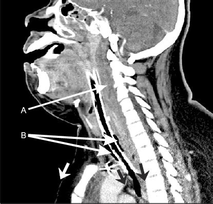 Midline Sagittal Computed Tomography Section Of Cervical Area Shows