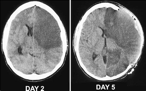 Hemicraniectomy In A 35 Year Old Woman With Malignant Left Mca Download Scientific Diagram