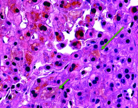 Hematoxylin And Eosin Hande Stain Of Core Liver Biopsy Showing Diffuse Download Scientific