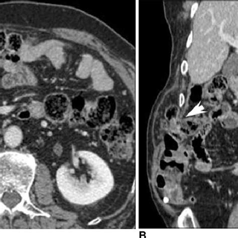 74 Year Old Man With Palpable Mass On Right Flank A Axial Mdct Scan Download Scientific