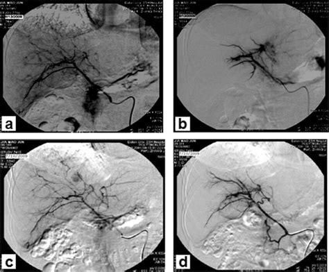 Hepatic Artery Angiography A Hepatic Arteriogram Shows Infiltrative