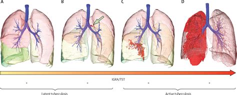 Tuberculosis Lungs Diagram