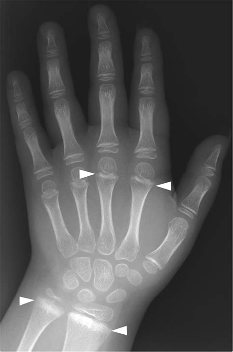 Phalangeal Microgeodic Syndrome In A 9 Year Old Boy With A History Of