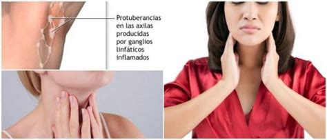 Ganglios Inflamados: Causas, Síntomas, Diagnóstico y Tratamiento - Arriba Salud