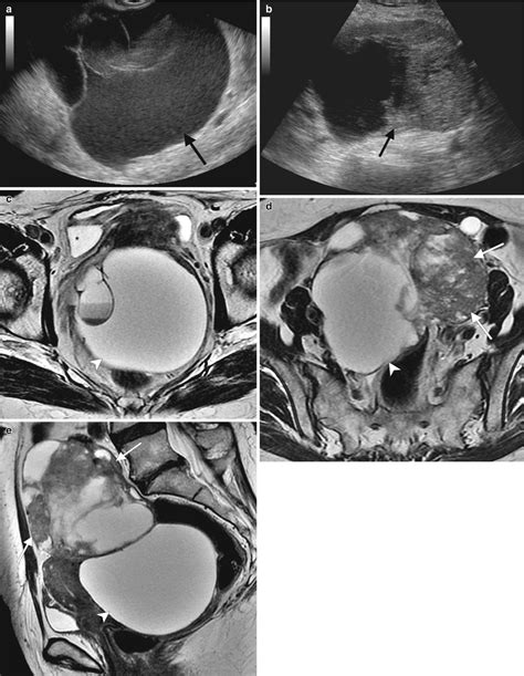 Ovarian Cancer Radiology Key