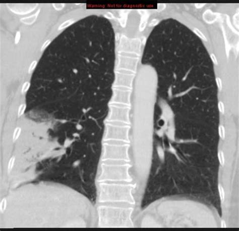 Adenocarcinoma In Situ Minimally Invasive Adenocarcinoma And Invasive