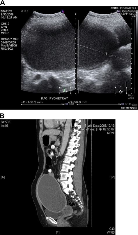 A A Transabdominal Ultrasound Examination Sagittal Plane Reveals A Download Scientific