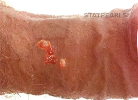 [figure Bowenoid Papulosis] Statpearls Ncbi Bookshelf