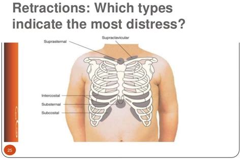 Image result for retractions | Lecture, Er nurse, Nicu nurse