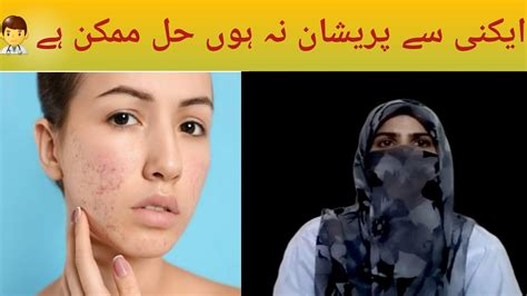 Chehre K Dano Ka Fori Ilaj Acne Treatment How To Get Rid Of Acne