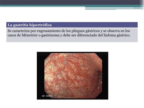 Gastritis Y Ulcera Péptica Ppt