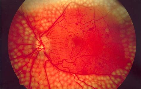 Diabetic Retinopathy: Symptoms, Prevention and Treatment