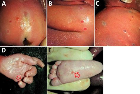 Figure 1 Congenital Mpox Syndrome Clade I In Stillborn Fetus After