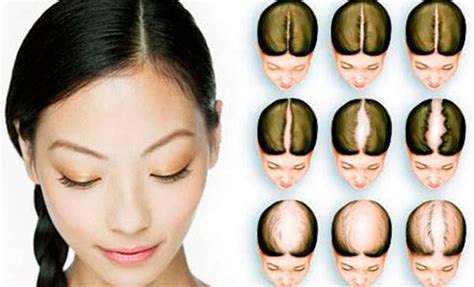 Androgenetic Alopecia Symptoms In Women