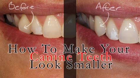 How To Make Your Big Canine Teeth Fang Teeth Look Smaller Youtube