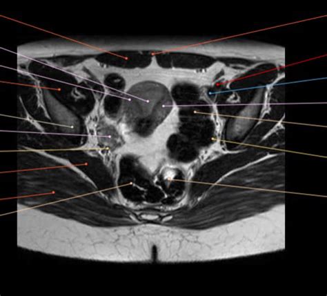 Diagram Of Female Pelvis Axial Mri Quizlet