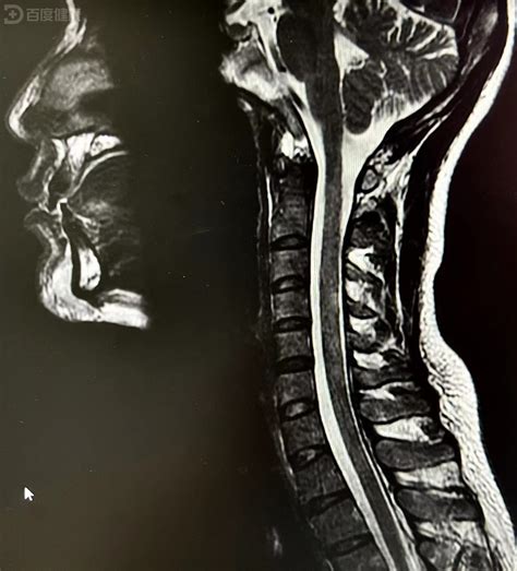 患者出现四肢麻木无力，竟是脊髓炎导致高位截瘫